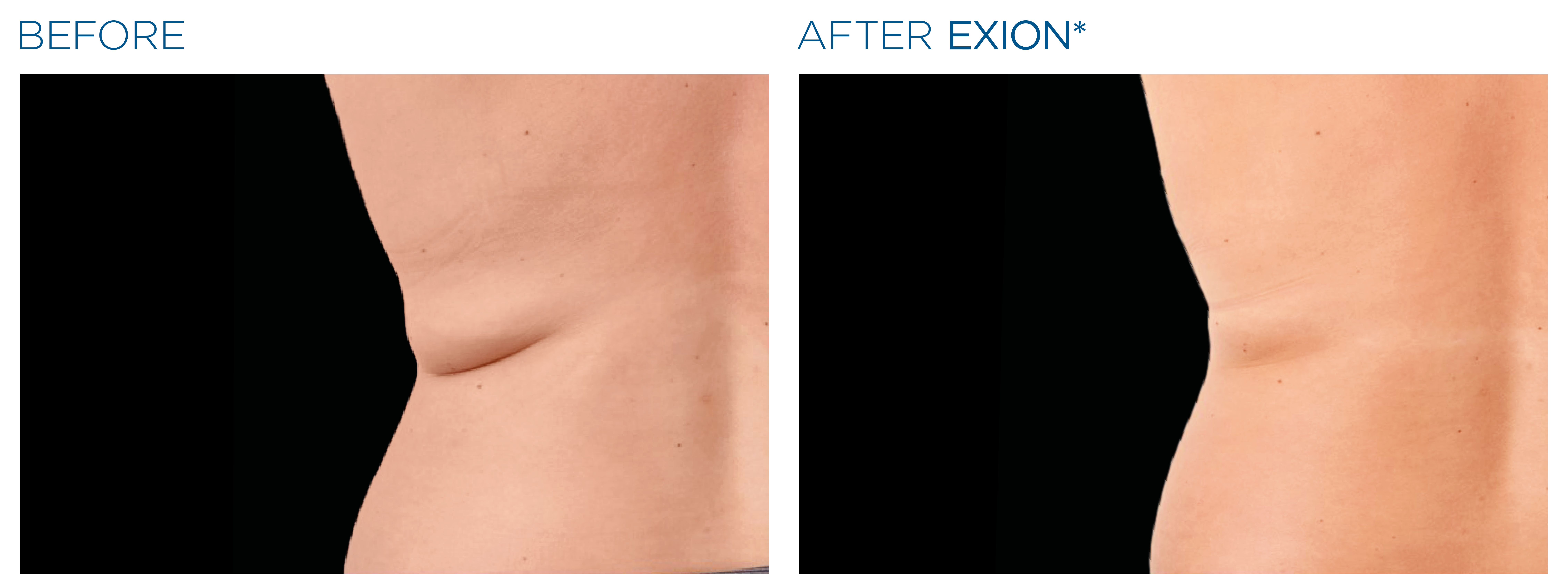 EXION Body before and after — love handles