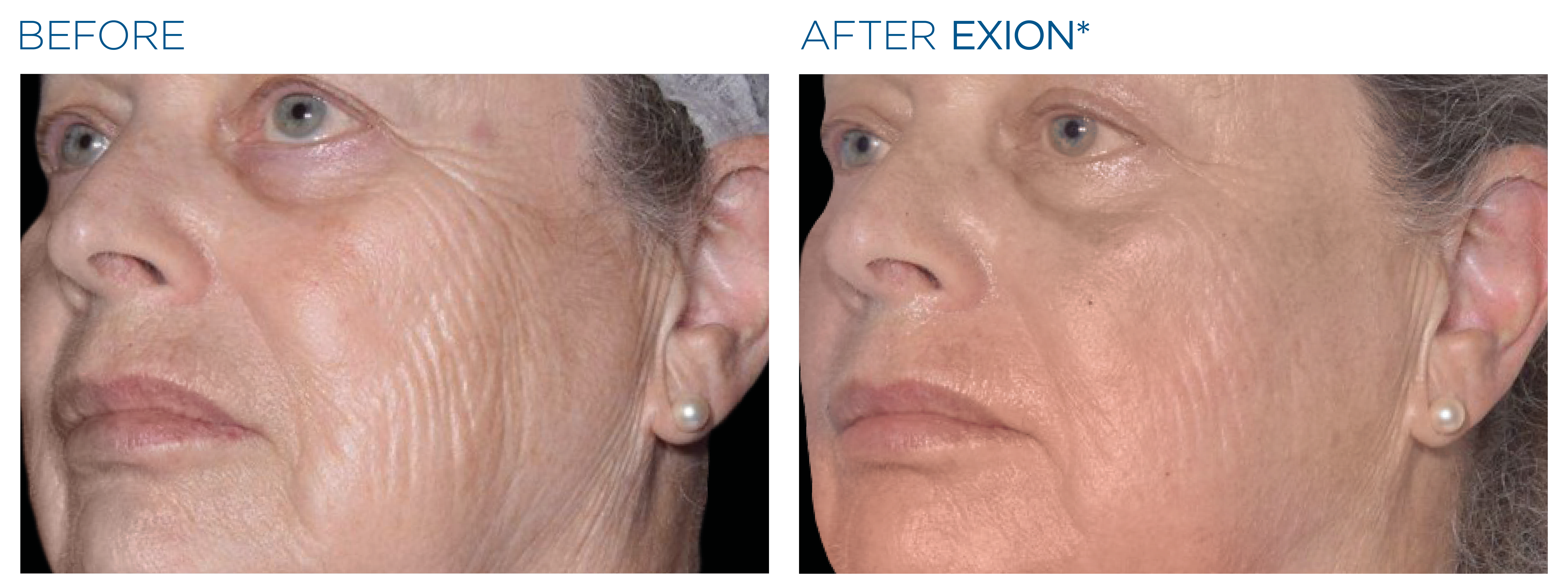 EXION RF before and after — lines and skin texture