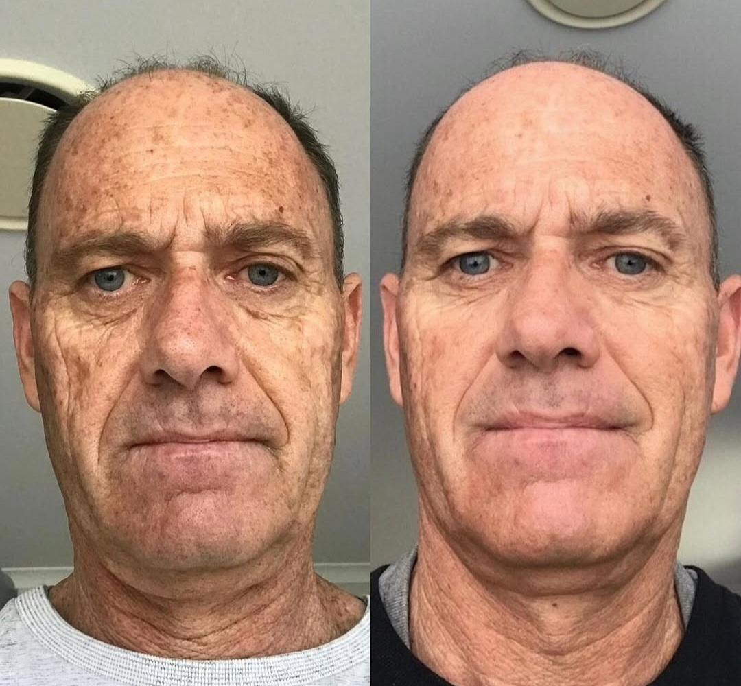 A client before and after one month on an Osmosis de-pigmentation and liver repair protocol