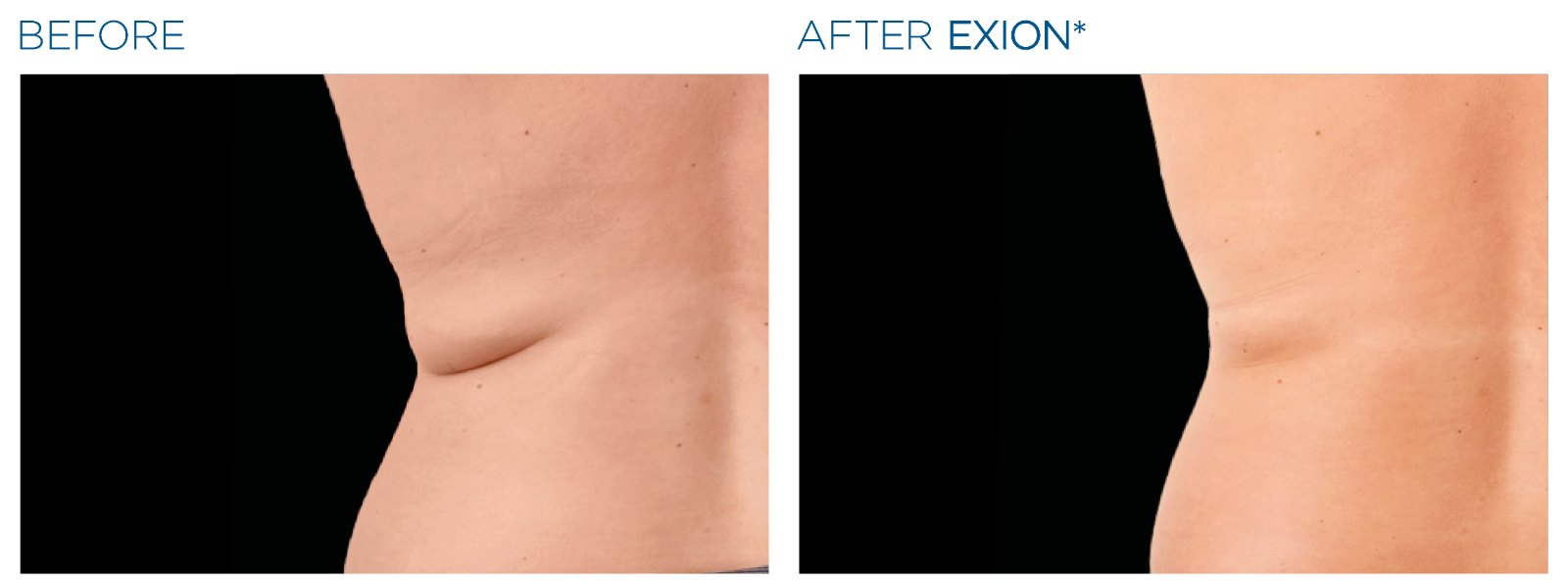 EXION Body before and after — love handles