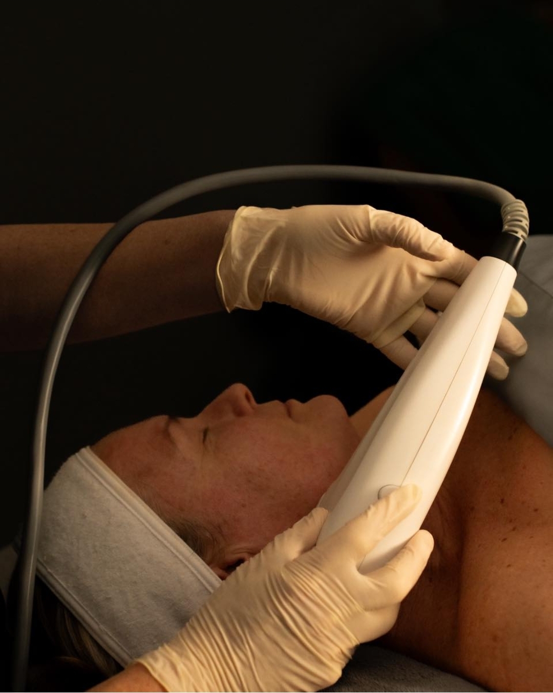 A HIFU treatment being performed along the jawline